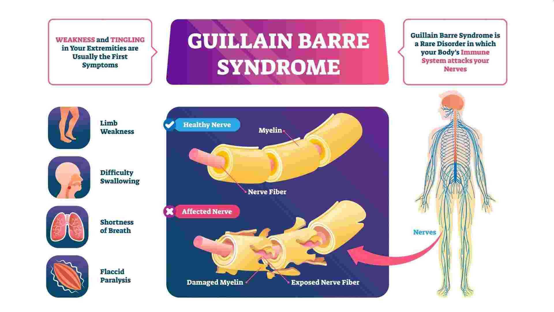 what-is-guillain-barre-syndrome-that-some-are-getting-post-covid-19-odishabytes