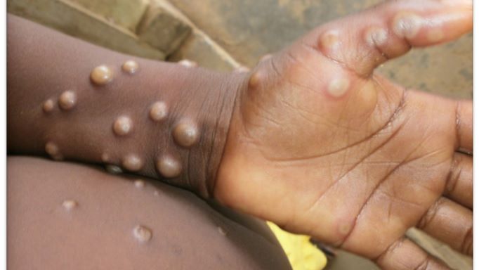 monkeypox in 92 nations, up 20%