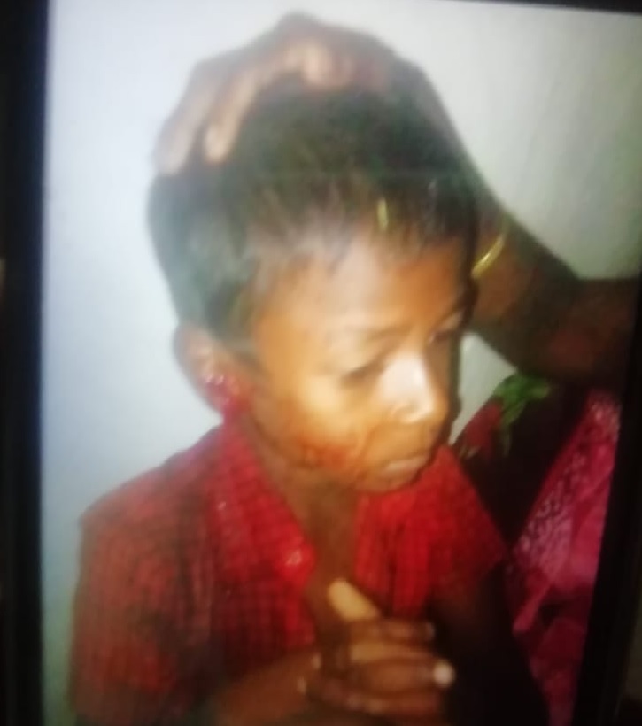 A minor child has been injured in a third leopard attack in Odisha’s Nuapada