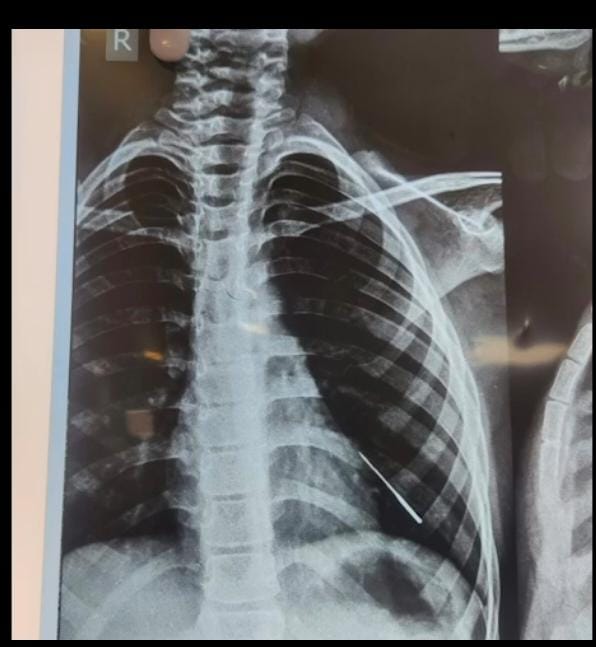 AIIMS bhubaneswar removed needle in boy's lung